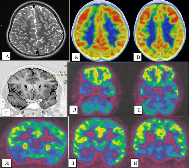 Субатрофические изменения мозга. Глиозные изменения головного мозга на кт.
